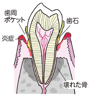 歯周病