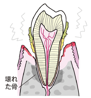 歯槽膿漏
