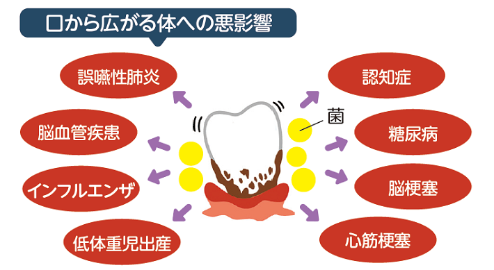 歯周病から全身へ広がる病気