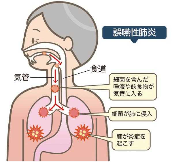 誤嚥性肺炎