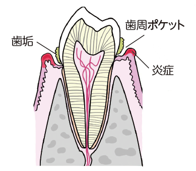歯周病のはじまり