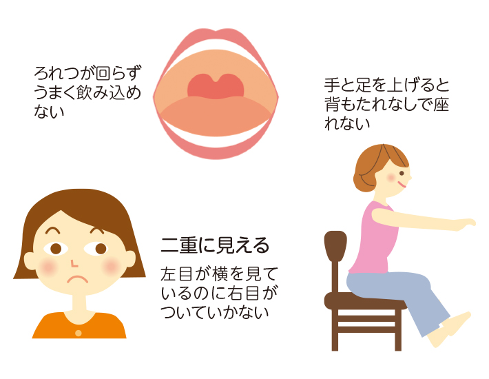 中枢性めまいの可能性がある賞状