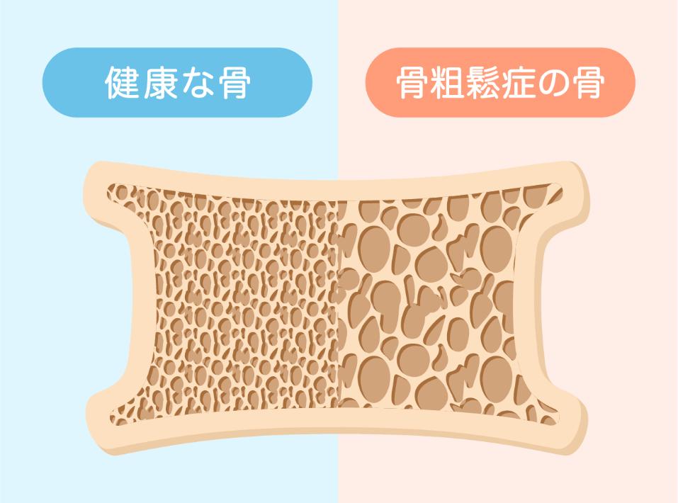 骨がもろいだけじゃない！？放置すると恐ろしい骨粗しょう症