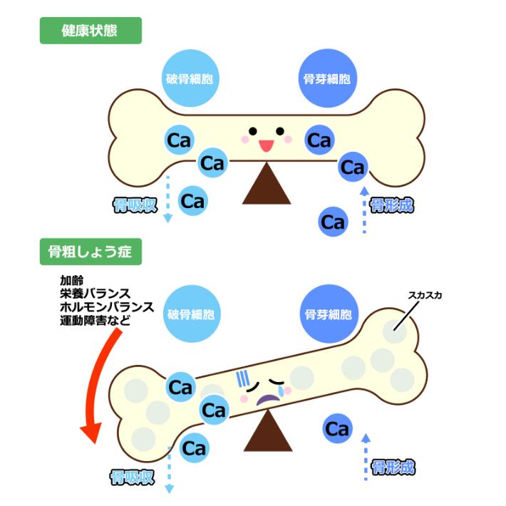 骨がもろいだけじゃない!?放置すると恐ろしい骨粗しょう症
