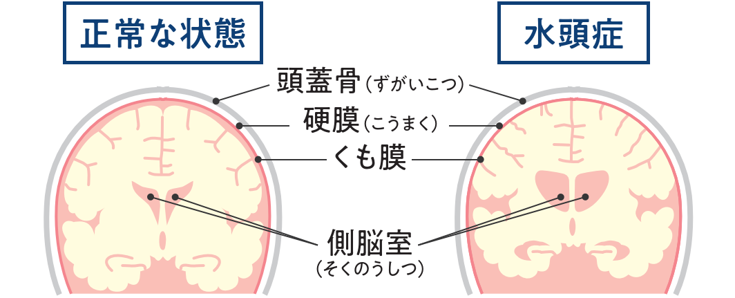 特発性正常圧水頭症の特徴的な症状