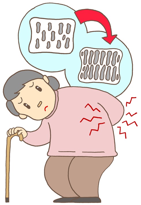 骨粗しょう症