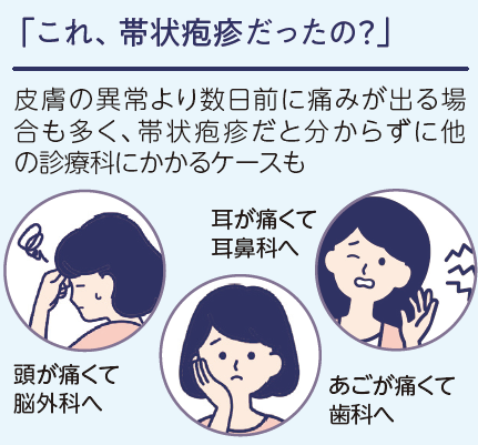 帯状疱疹の症状