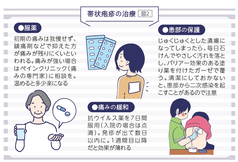 帯状疱疹の治療