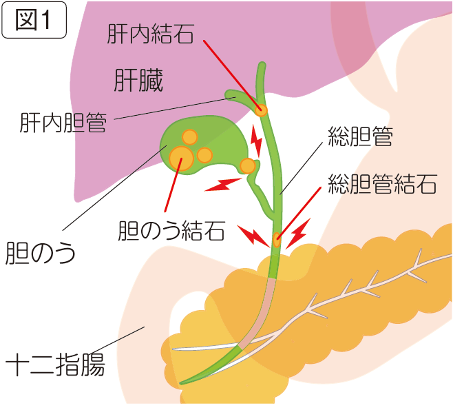 胆石症のはなし 胆石のできる場所