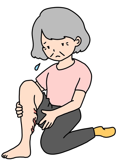 下肢静脈瘤