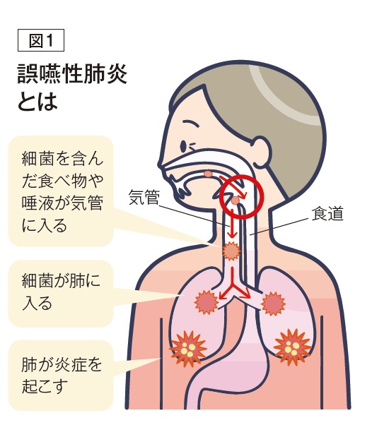 図1 誤嚥性肺炎とは