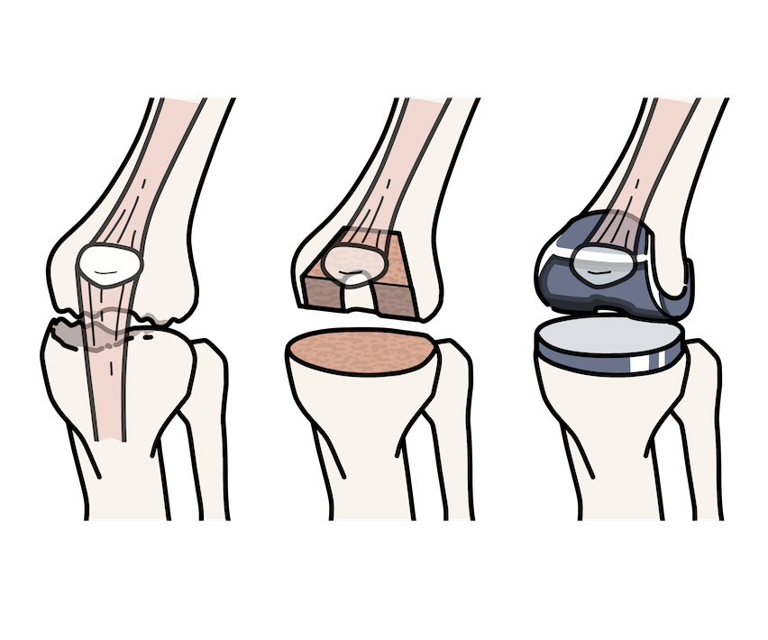 加齢とともに増える疾患　変形性膝関節症とは？