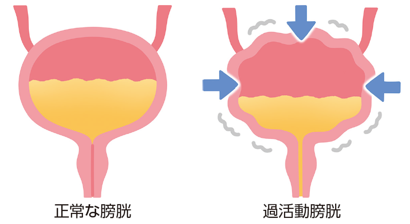 尿の悩み、放置しないで 過活動膀胱とは