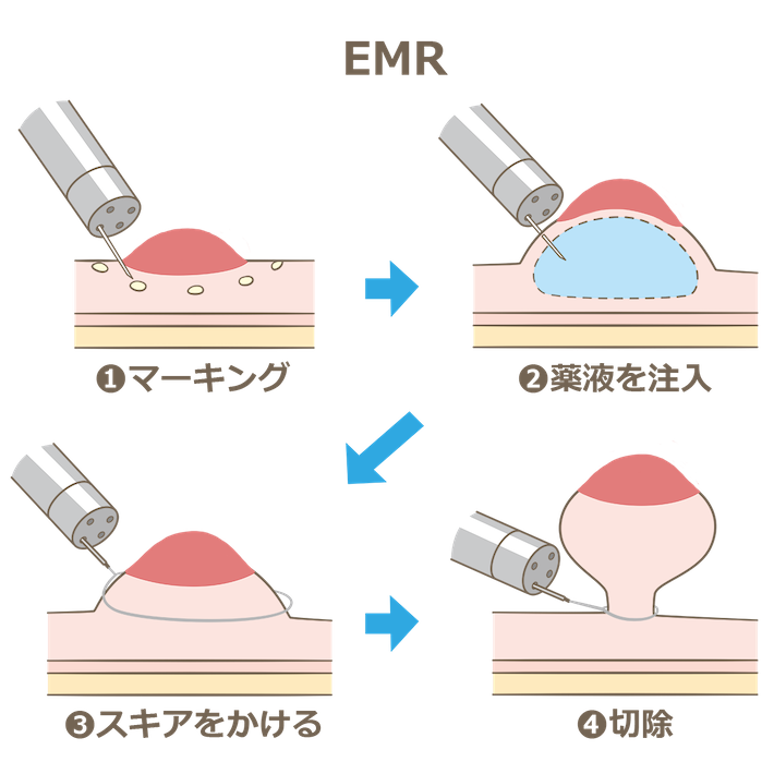 早期発見で自分を守ろう 大腸がんと検査の話