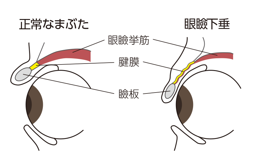 まぶたが下がってくる病気 知っていますか? 眼瞼下垂